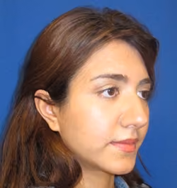 Rhinoplasty before and after, case 2950 - Cool Springs Plastic Surgery