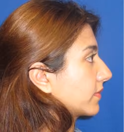 Rhinoplasty before and after, case 2950 - Cool Springs Plastic Surgery