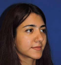 Rhinoplasty before and after, case 2950 - Cool Springs Plastic Surgery