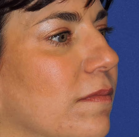 Rhinoplasty before and after, case 3005 - Cool Springs Plastic Surgery
