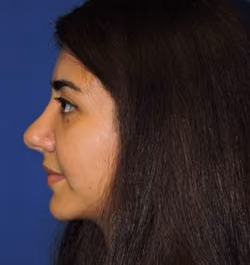 Rhinoplasty before and after, case 2950 - Cool Springs Plastic Surgery