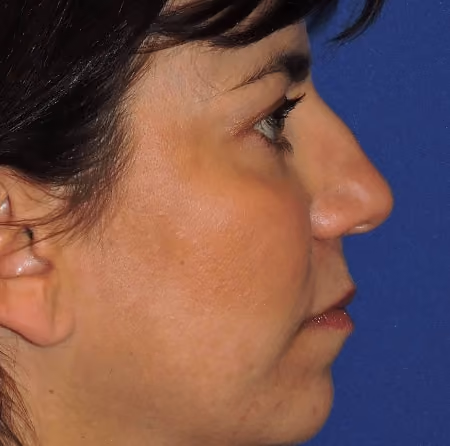 Rhinoplasty before and after, case 3005 - Cool Springs Plastic Surgery