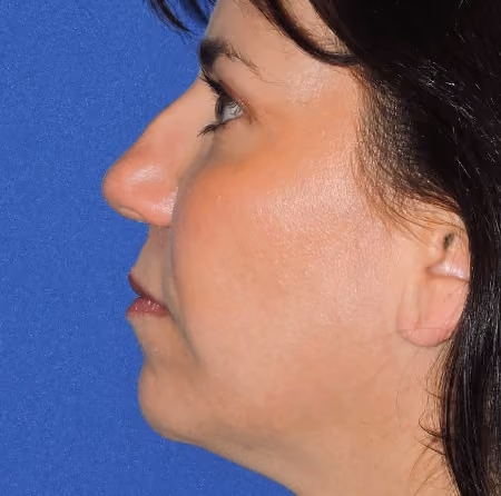 Rhinoplasty before and after, case 3005 - Cool Springs Plastic Surgery