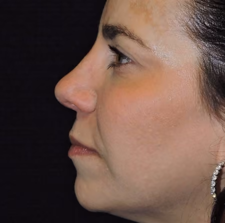 Rhinoplasty before and after, case 3005 - Cool Springs Plastic Surgery