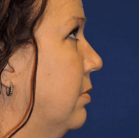 Rhinoplasty before and after, case 3041 - Cool Springs Plastic Surgery