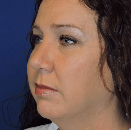 Rhinoplasty before and after, case 3041 - Cool Springs Plastic Surgery