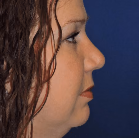 Rhinoplasty before and after, case 3041 - Cool Springs Plastic Surgery