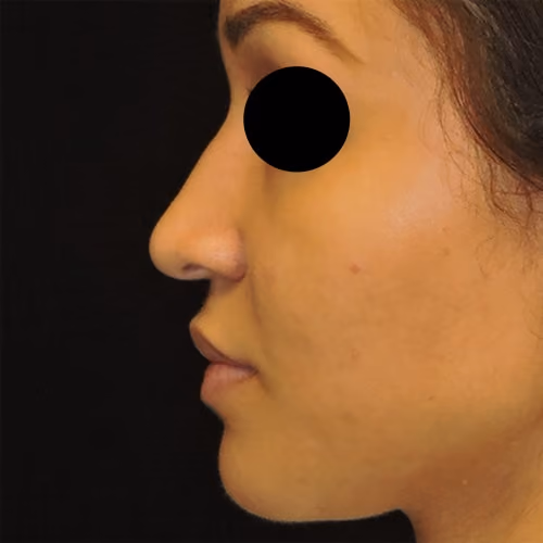 Rhinoplasty before and after, case 3093 - Cool Springs Plastic Surgery