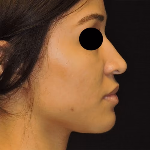 Rhinoplasty before and after, case 3093 - Cool Springs Plastic Surgery