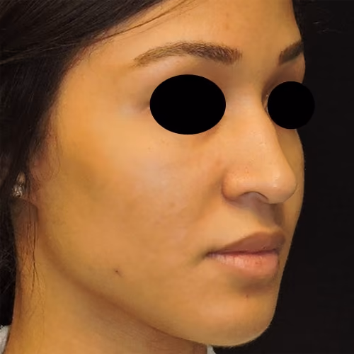 Rhinoplasty before and after, case 3093 - Cool Springs Plastic Surgery