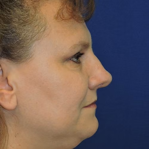 Rhinoplasty before and after, case 5761 - Cool Springs Plastic Surgery