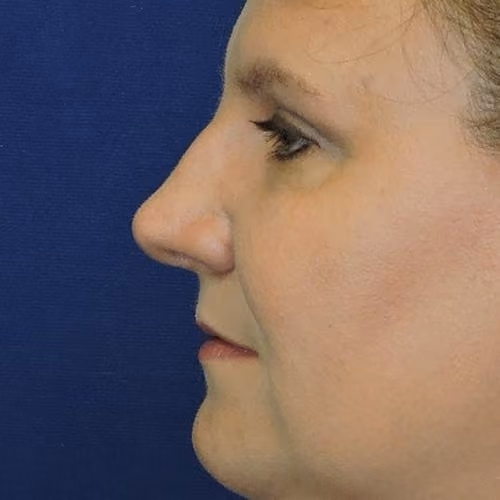 Rhinoplasty before and after, case 5761 - Cool Springs Plastic Surgery