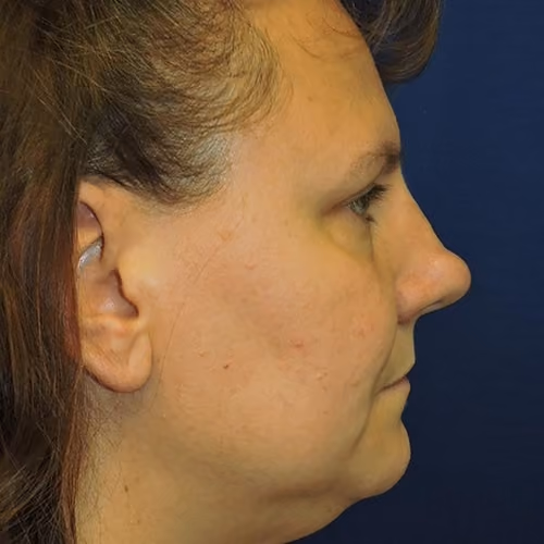 Rhinoplasty before and after, case 5761 - Cool Springs Plastic Surgery