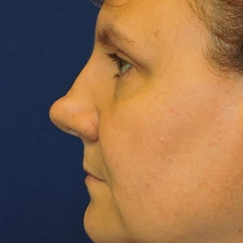 Rhinoplasty before and after, case 5761 - Cool Springs Plastic Surgery