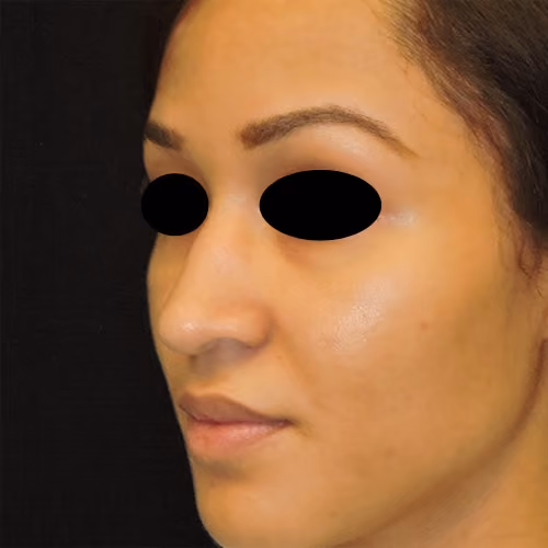 Rhinoplasty before and after, case 3093 - Cool Springs Plastic Surgery