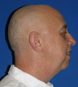 Facelift before and after, case 2300 - Cool Springs Plastic Surgery