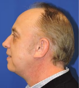 Facelift before and after, case 2300 - Cool Springs Plastic Surgery