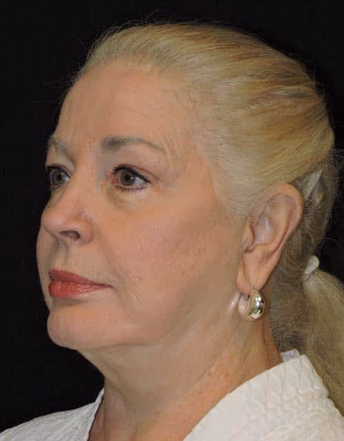 Facelift before and after, case 2344 - Cool Springs Plastic Surgery