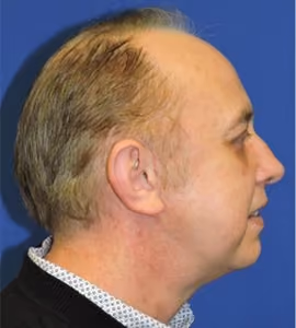 Facelift before and after, case 2300 - Cool Springs Plastic Surgery