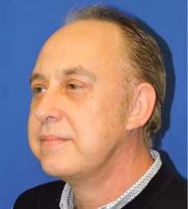 Facelift before and after, case 2300 - Cool Springs Plastic Surgery