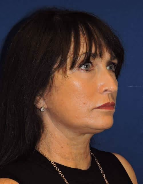 Facelift before and after, case 2364 - Cool Springs Plastic Surgery