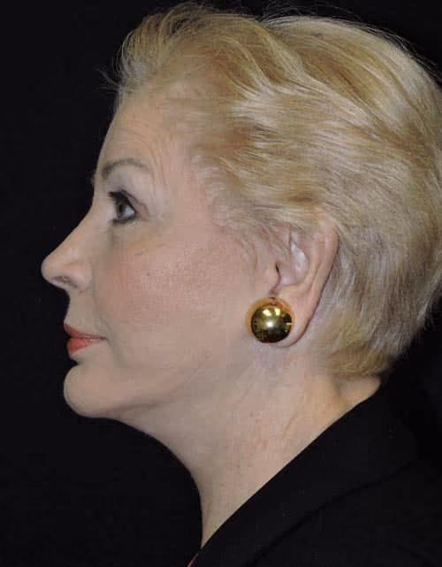 Facelift before and after, case 2344 - Cool Springs Plastic Surgery