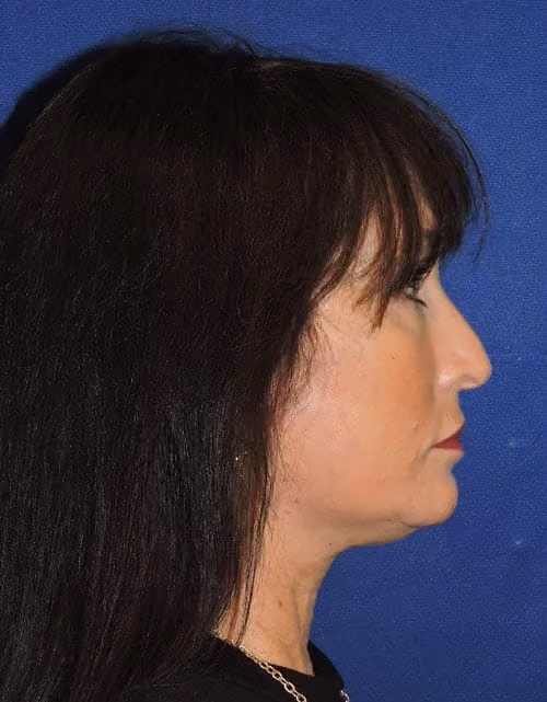 Facelift before and after, case 2364 - Cool Springs Plastic Surgery