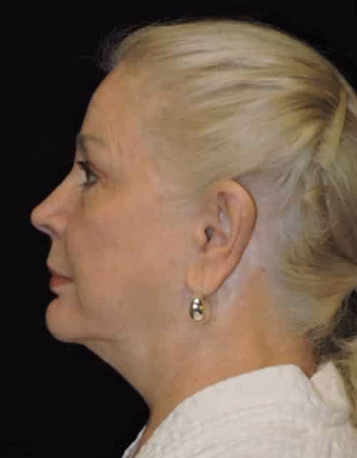 Facelift before and after, case 2344 - Cool Springs Plastic Surgery