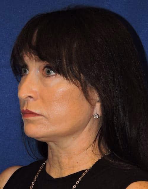 Facelift before and after, case 2364 - Cool Springs Plastic Surgery
