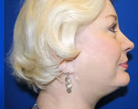 Facelift before and after, case 2483 - Cool Springs Plastic Surgery