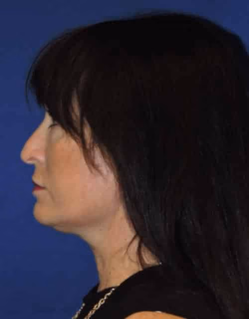 Facelift before and after, case 2364 - Cool Springs Plastic Surgery