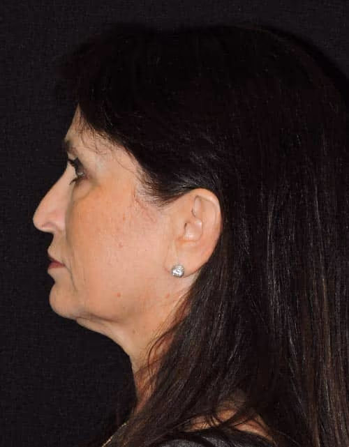 Facelift before and after, case 2364 - Cool Springs Plastic Surgery