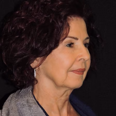 Facelift before and after, case 2913 - Cool Springs Plastic Surgery