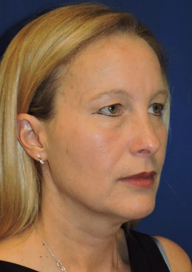 Facelift before and after, case 2892 - Cool Springs Plastic Surgery