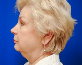 Facelift before and after, case 2483 - Cool Springs Plastic Surgery