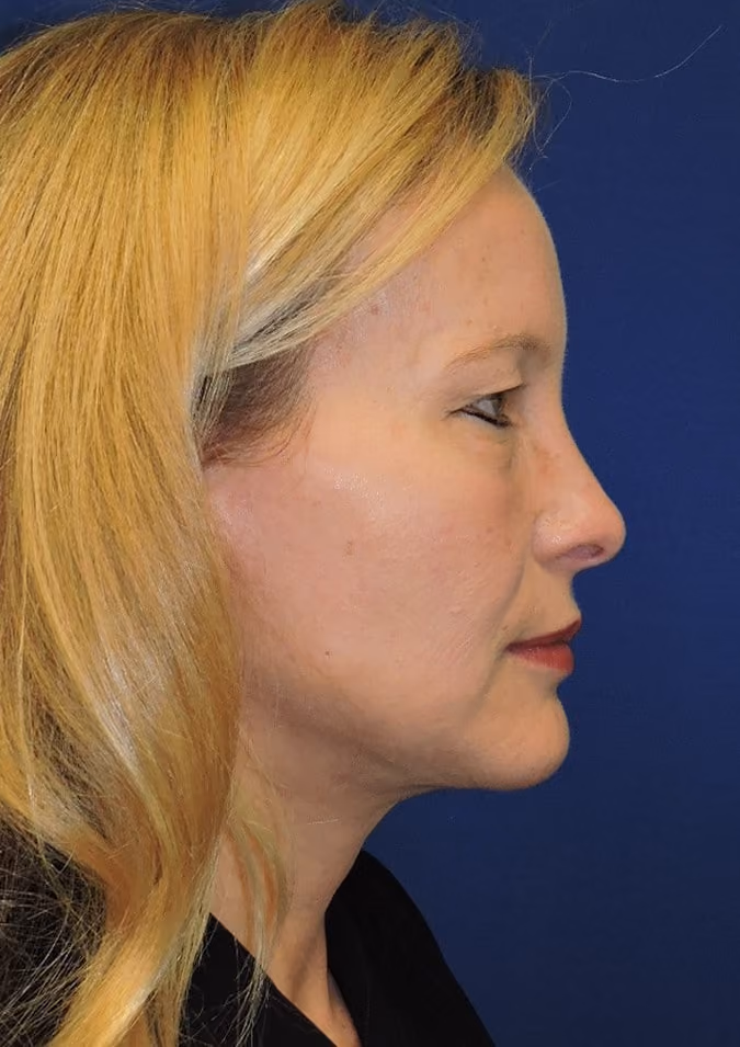 Facelift before and after, case 2892 - Cool Springs Plastic Surgery