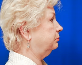 Facelift before and after, case 2483 - Cool Springs Plastic Surgery
