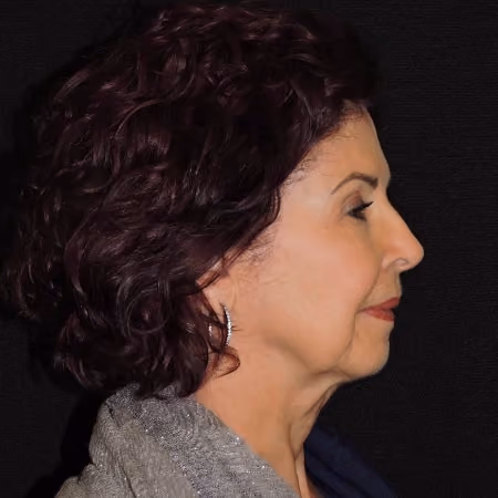 Facelift before and after, case 2913 - Cool Springs Plastic Surgery