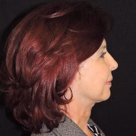 Facelift before and after, case 2913 - Cool Springs Plastic Surgery