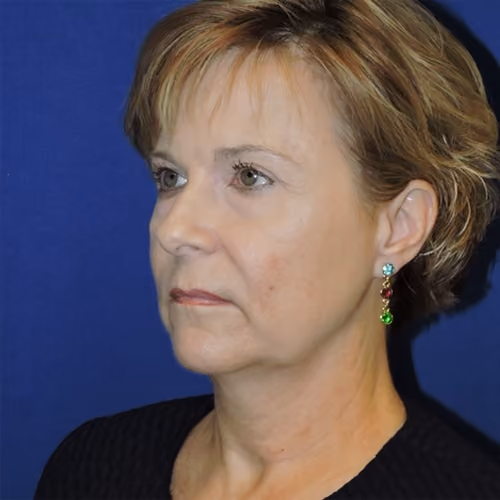 Facelift before and after, case 3107 - Cool Springs Plastic Surgery