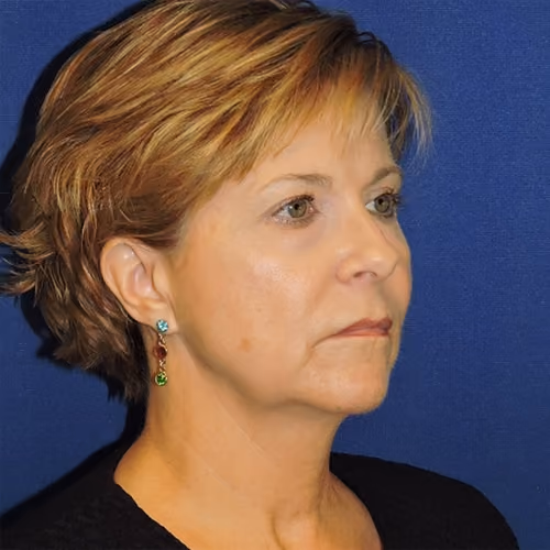 Facelift before and after, case 3107 - Cool Springs Plastic Surgery
