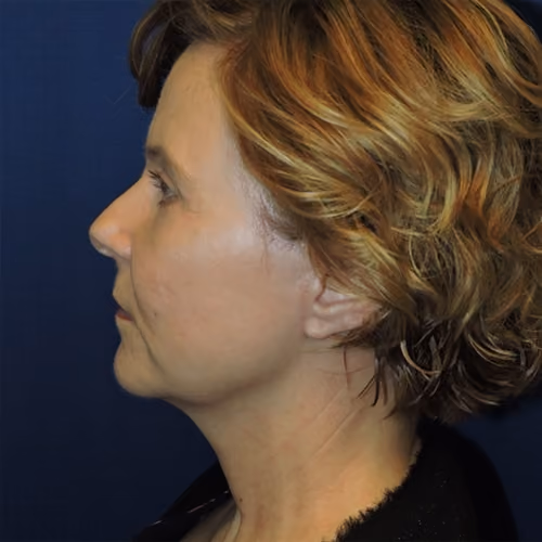 Facelift before and after, case 3107 - Cool Springs Plastic Surgery