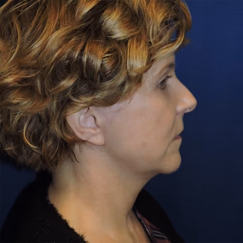 Facelift before and after, case 3107 - Cool Springs Plastic Surgery