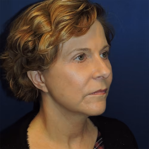 Facelift before and after, case 3107 - Cool Springs Plastic Surgery