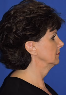 Facelift before and after, case 3375 - Cool Springs Plastic Surgery