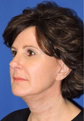 Facelift before and after, case 3375 - Cool Springs Plastic Surgery