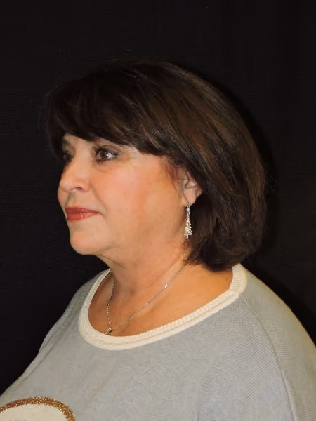 Facelift before and after, case 3288 - Cool Springs Plastic Surgery