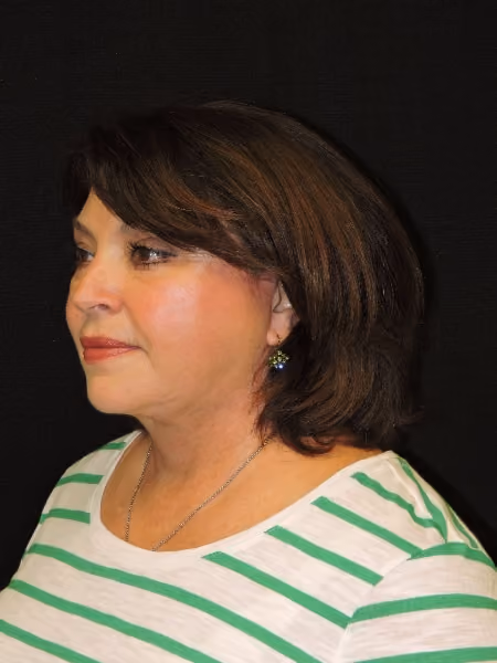 Facelift before and after, case 3288 - Cool Springs Plastic Surgery