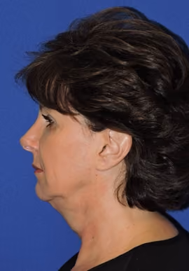 Facelift before and after, case 3375 - Cool Springs Plastic Surgery