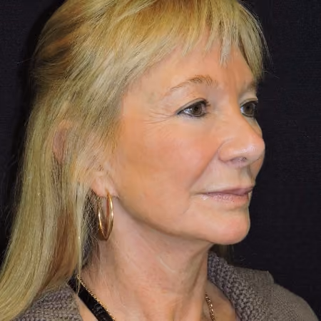 Facelift before and after, case 3459 - Cool Springs Plastic Surgery